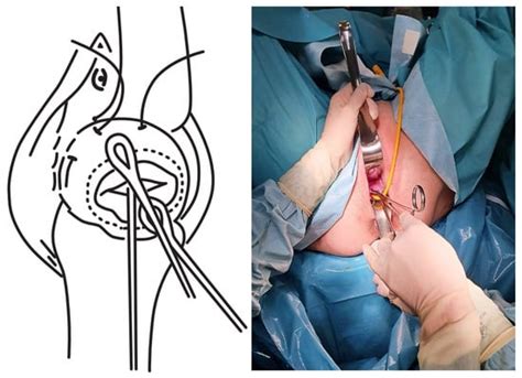 IJERPH | Free Full-Text | A Three-Step Procedure for Emergency Cerclage ...