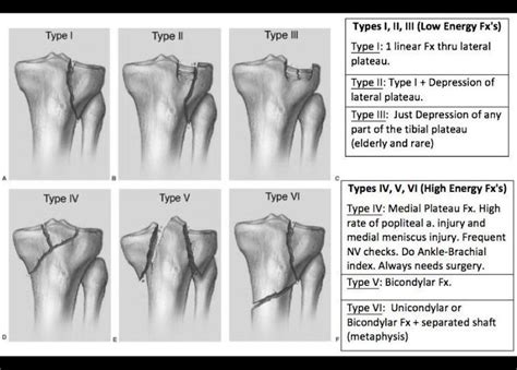 Schatzker Tibial Plateau Fracture Classification | Radiology technician ...