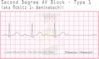 ECG Educator Blog : Heart Blocks