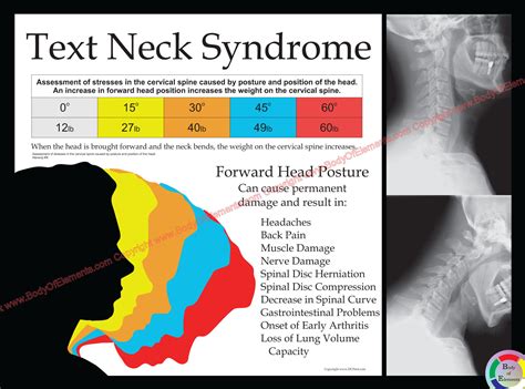 Text Neck Syndrome Poster