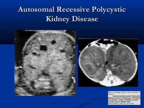 Cystic Renal Disease