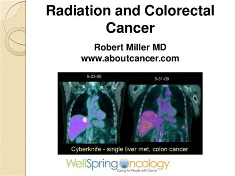 Radiation for Colon and Rectal Cancer