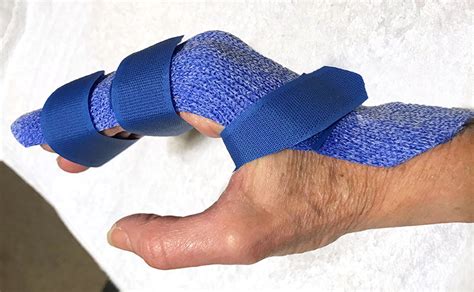 Relative Motion Flexion Splinting For The Rehabilitation Of, 41% OFF