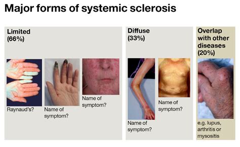 Scleroderma: Types, Symptoms & Treatment » How To Relief