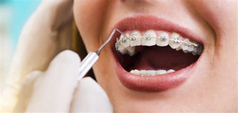 5 Teeth Alignment Options to Improve Your Smile - Mom Blog Society