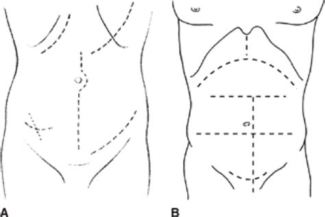 Abdominal Wall Incisions and Repair Including Release | Basicmedical Key