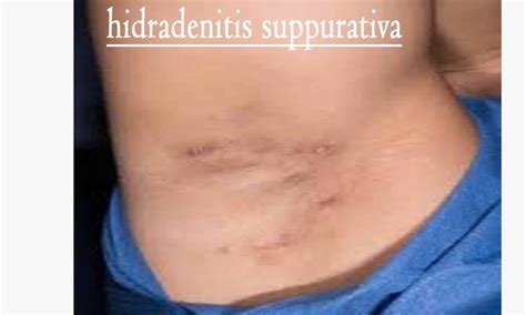 Dapsone effective treatment of severe hidradenitis suppurativa