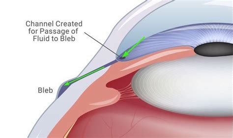 Trabeculectomy – Ramapo Eye Care