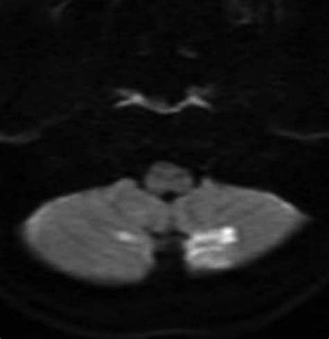 MRI diffusion imaging on day 1. | Download Scientific Diagram