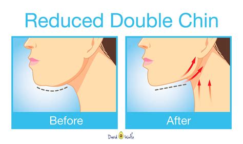 The Best Exercises For Getting Rid Of That Unwanted Double Chin & Neck Fat - David Avocado Wolfe