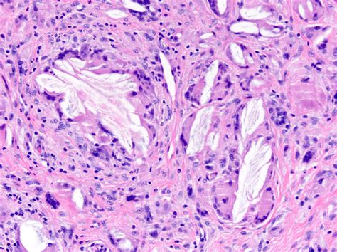 Epidermal Inclusion Cyst Removal