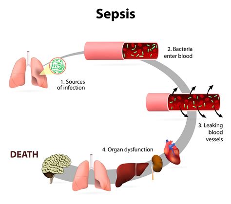 Circulating Biomarkers in Critical Illness and Sepsis | BioVendor R&D