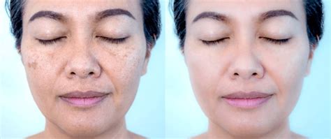 243 Before After Melasma Images, Stock Photos, 3D objects, & Vectors | Shutterstock