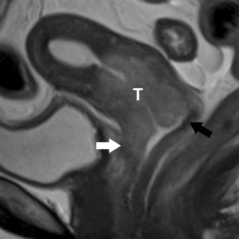 FIGO staging of endometrial carcinoma and corresponding MR findings ...