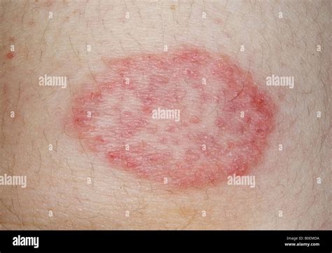 ringworm fungus infection of the skin Stock Photo - Alamy