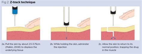 Z-Track Technique for IM Injection – BuyNeedles.ca