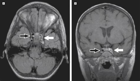 Rhino-orbital Mucormycosis Causing Cavernous Sinus and Internal Carotid Thrombosis Treated With ...