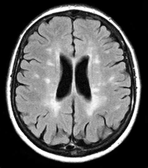 Multiple Sclerosis, Mri Scan Photograph by Du Cane Medical Imaging Ltd