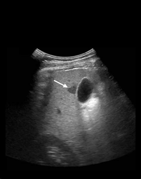 🔥FOCAL FATTY SPARING IN A... - Ultrasound Guided Tips | Facebook