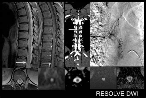 Figure 1 from MRI diagnosis of spinal cord lesions with emphasis on diffusion-weighted imaging ...