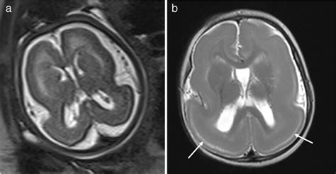 Lissencephaly Mri