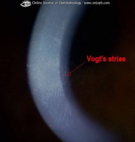 Medicine Decoded: Eponyms about Vogt - Ophthalmology