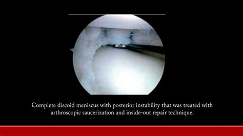 PPT - Discoid Meniscus Treatment PowerPoint Presentation, free download - ID:9391922