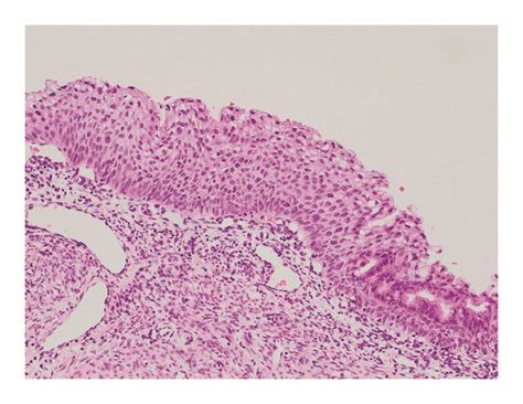 Intraepithelial lesions. (a) H-E stain. Endocervical lesions.... | Download Scientific Diagram