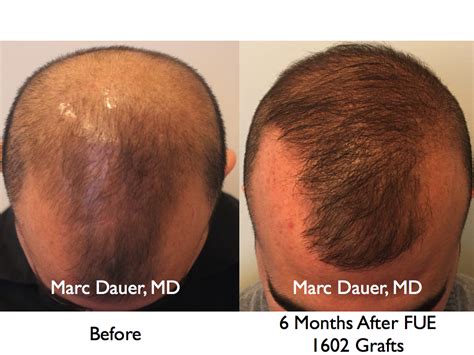 FUE Hair Transplant AT 6 Months | Marc Dauer, MD Hair Transplant Doctor Los Angeles