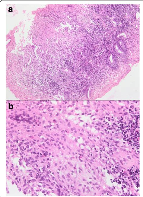 Biopsy from the sigmoid colon. a Colonic biopsy showing histiocytoid ...