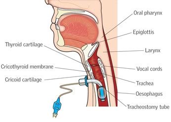 Tracheostomy Care