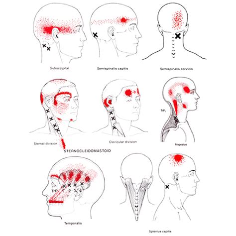 Tips to keep going through a headache? : r/TheGirlSurvivalGuide