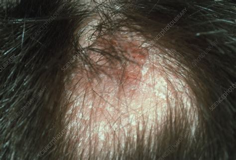 Tinea capitis ringworm of the scalp - Stock Image - M270/0085 - Science Photo Library