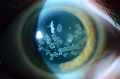 Corneal dystrophy | Wills Eye Hospital