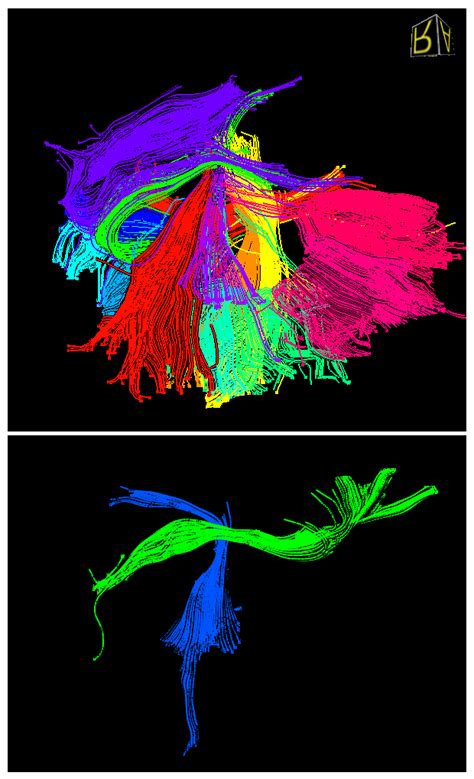 Examples of a fiber bundle using ROIs (top) and clustering using an ...