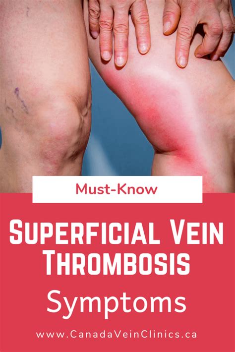 Superficial Vein Thrombosis: Complications of Varicose Veins | Canada Vein Clinics