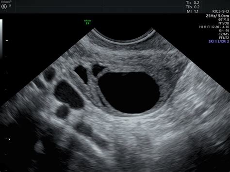 Uterine Cysts