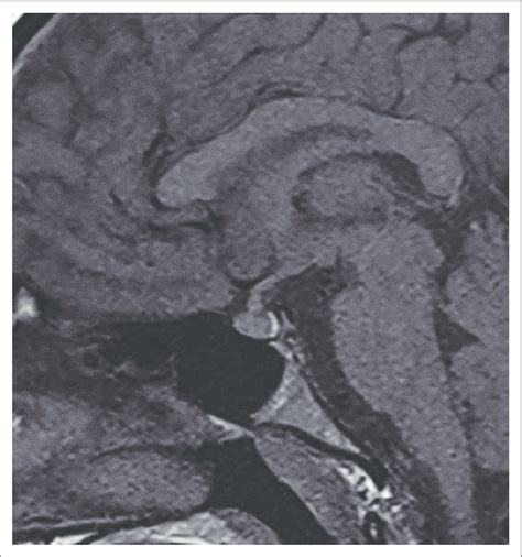 Unenhanced T1-weighted image reveals thickening of the pituitary stalk ...