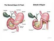 Billroth II Repair Medical Illustration MediVisuals