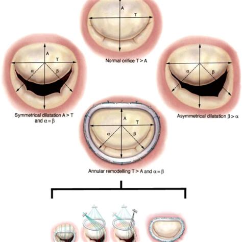 Commercially available bioprosthetic mitral valves and annular rings ...