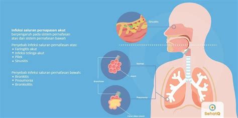 10 Penyebab Kematian Terbanyak di Dunia - Cultura