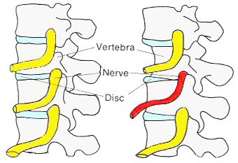 Pinched Nerve Treatment - Snyder Chiropractic & Wellness