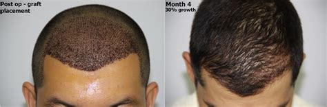 Hair Restoration Progression and Hair Growth Timeline - Alvi Armani - Hair Transplant Los Angeles