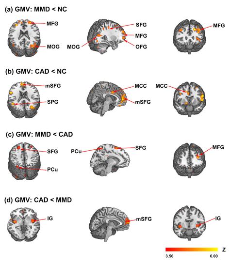 Comparison of gray matter volume (MRI T1) among patients and normal ...