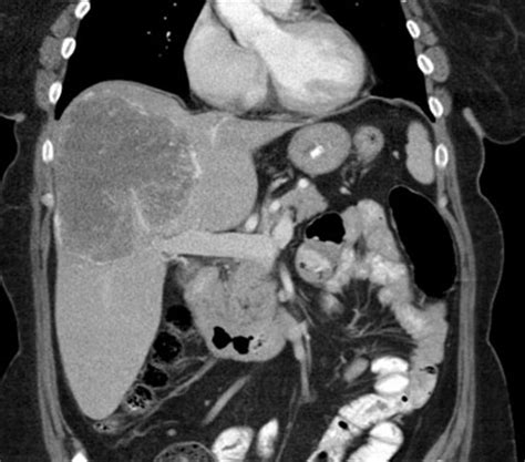 hepatopulmonary syndrome