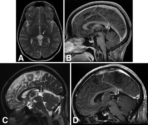 Preoperative brain MRI showing a pineal cyst: T2 axial sequence (A) and... | Download Scientific ...