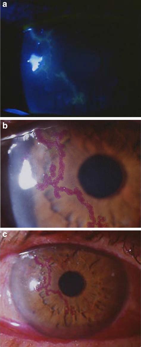 a Dendritic ulcer (Epithelial keratitis) highlighted by staining with... | Download Scientific ...