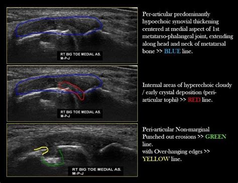 Gouty arthritis Radiology Imaging, Interventional Radiology, Sonography, Gout, Head And Neck ...