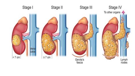 Kidney cancer treatment in India