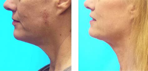 Chin Lift Photos - Before & After Pictures - Bozeman MT - Dr. McDaniel